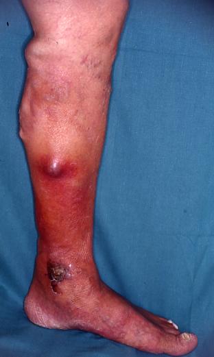 Ulcera alla gamba